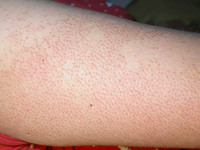 keratosis pilaris